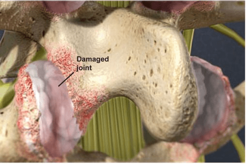 Cervical-Facet-Syndrome