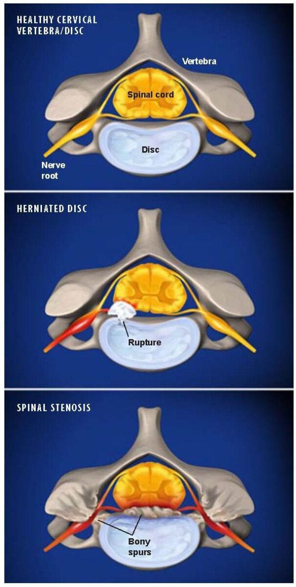 Cervical-Radiculopathy