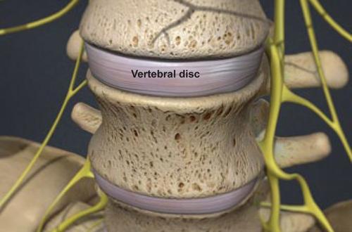 Degenerative-Disc-Disease