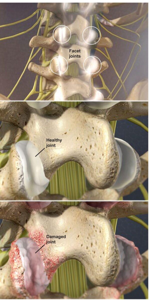 Facet-Joint-Syndrome