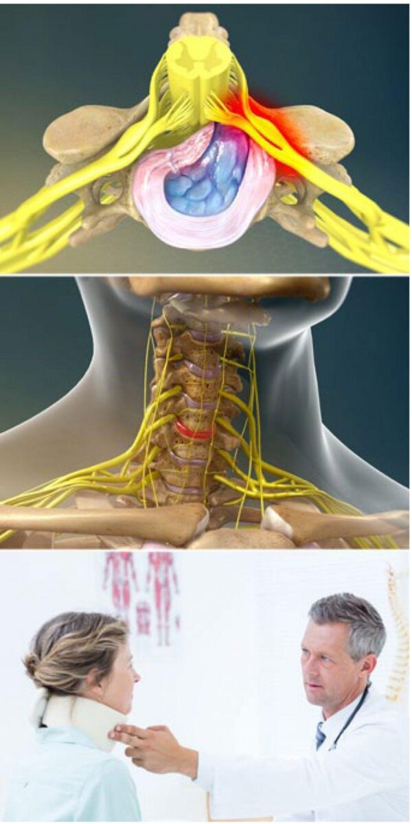 Herniated-Disc-Cervical