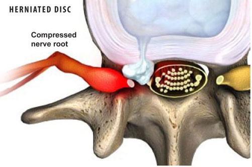 Herniated-Disc