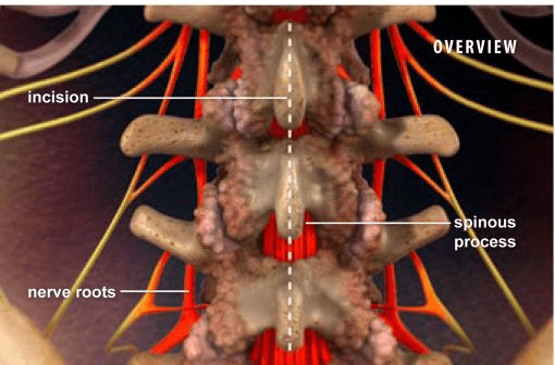 Laminectomy