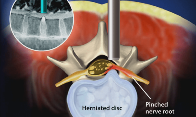Micro-Endoscopic-Discectomy