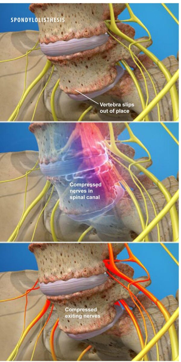 Spondylolisthesis