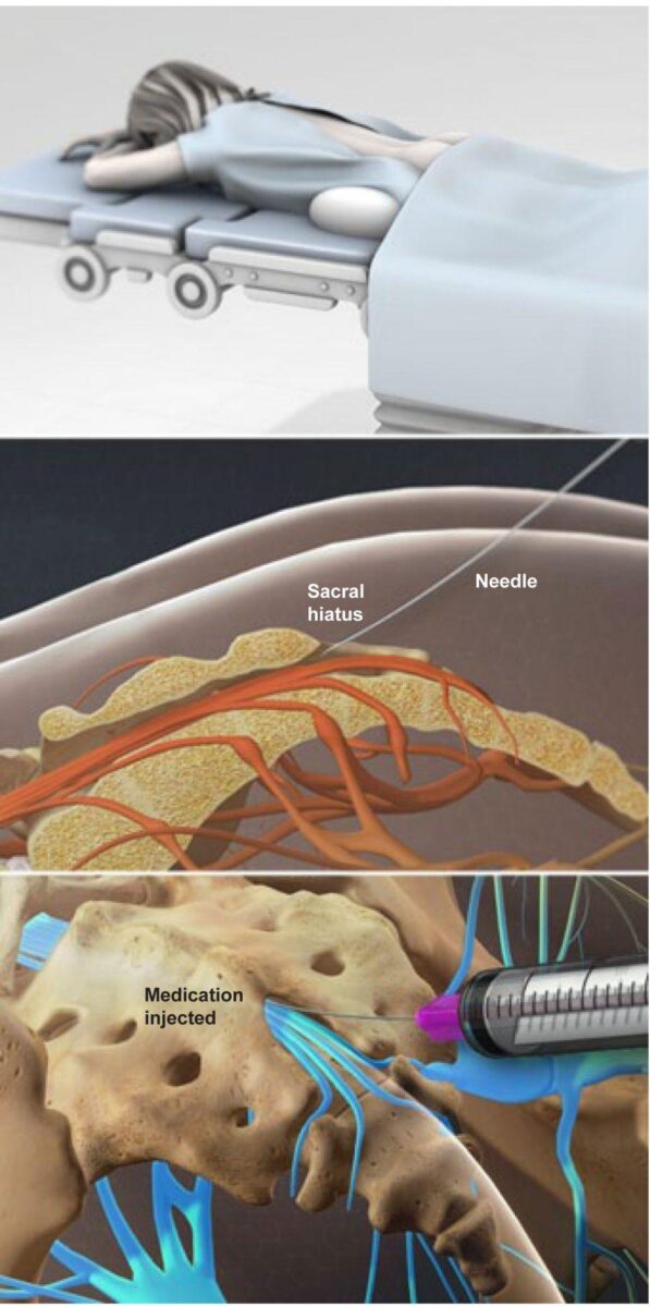 caudal-epidural-steroid-injection