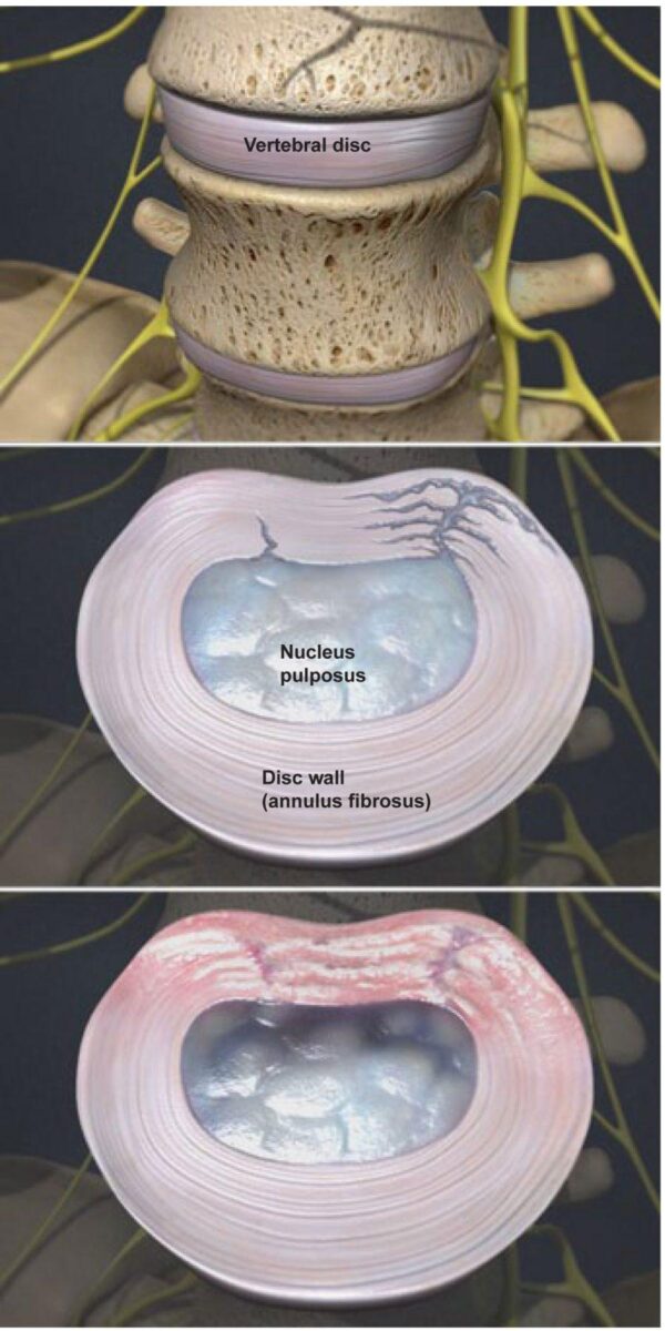 degenerative-disc-disease-page