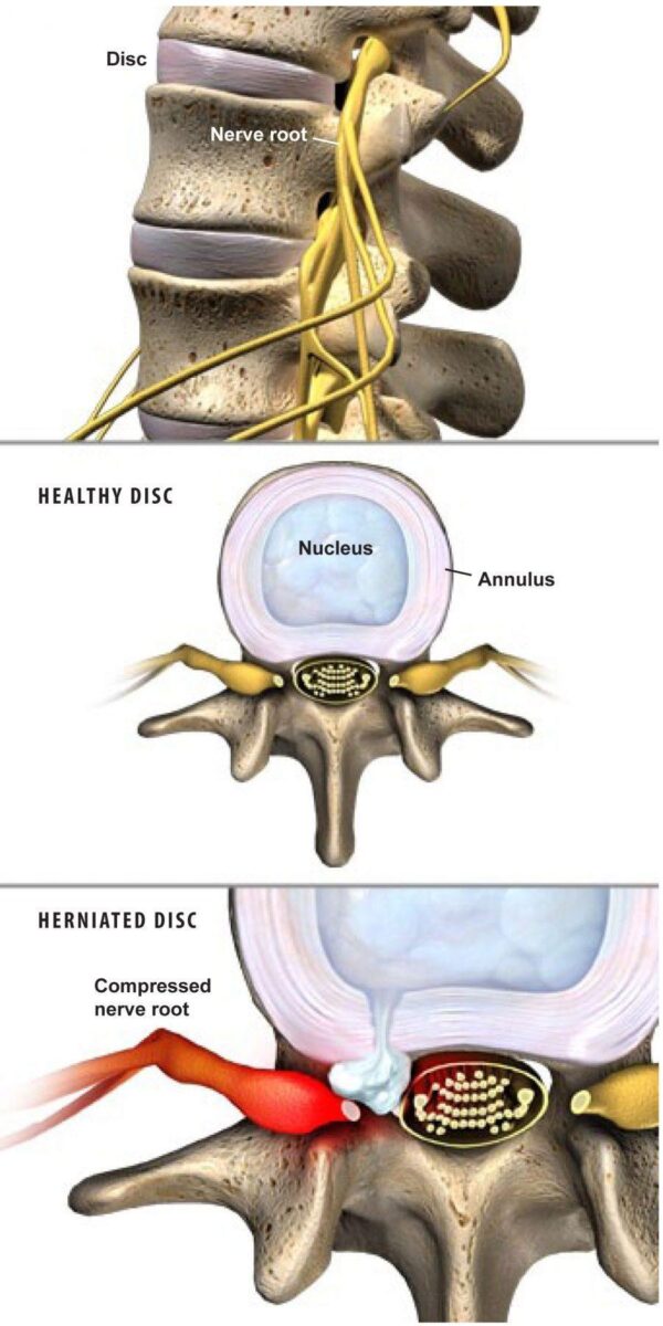 herniated-disc-pics