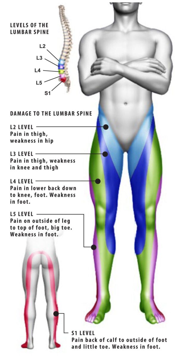 lumbar radiculopathy diagram