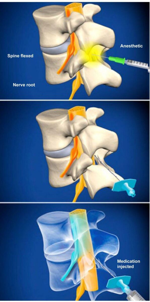 lumbar-epidural-steroid-injection-without-contrast