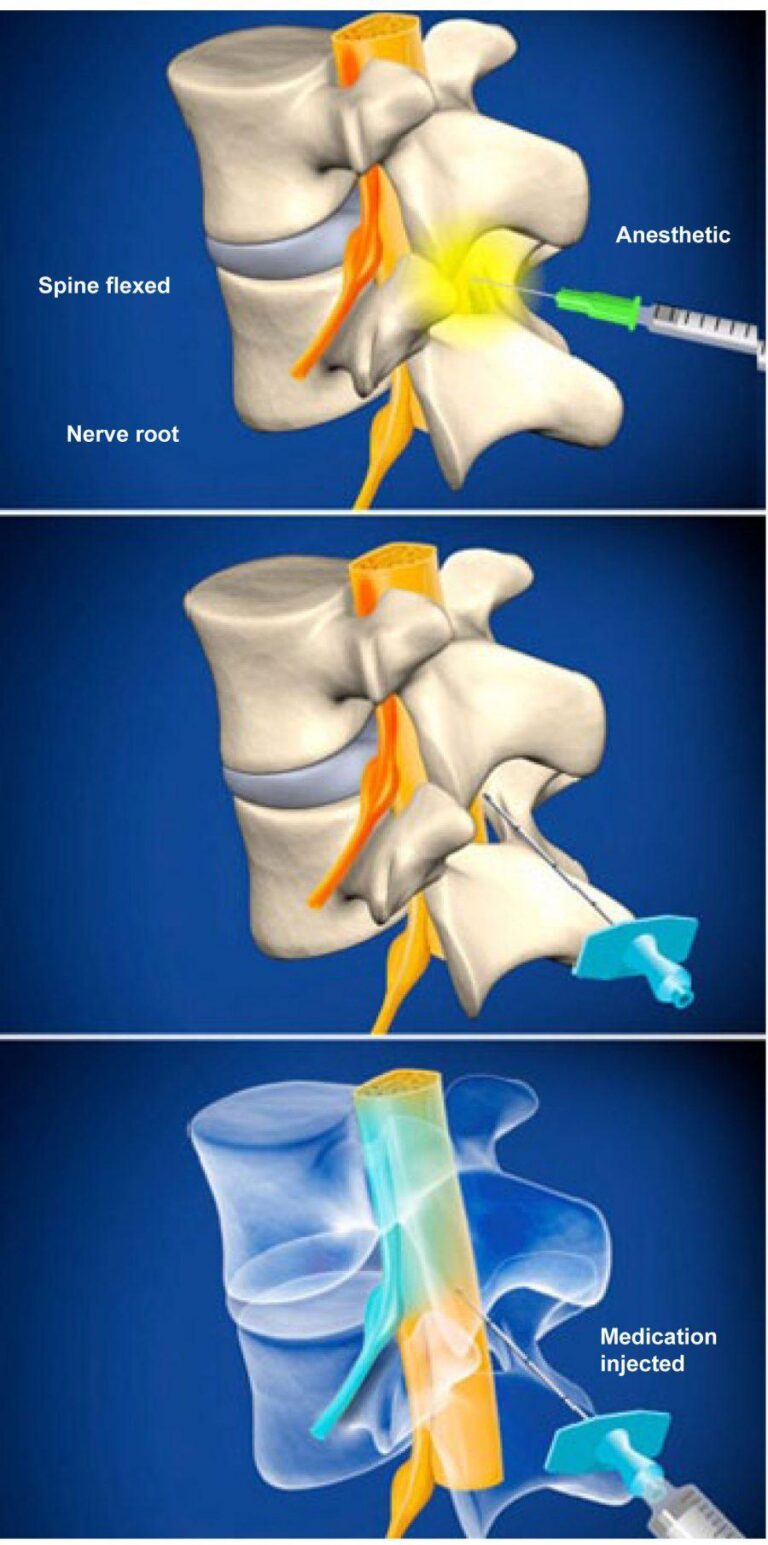 Lumbar Epidural Steroid Injection Without Contrast Advanced Spine Center