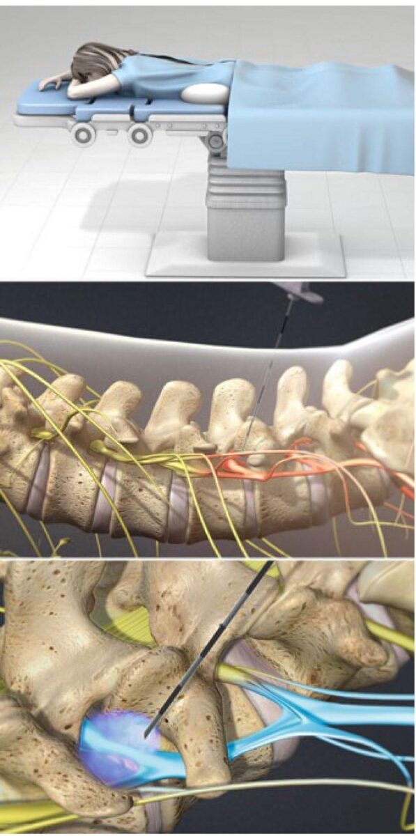 lumbar-transforaminal-epidural-steroid-injection