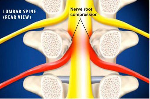 minimally-invasive-lumbar-microdecompression