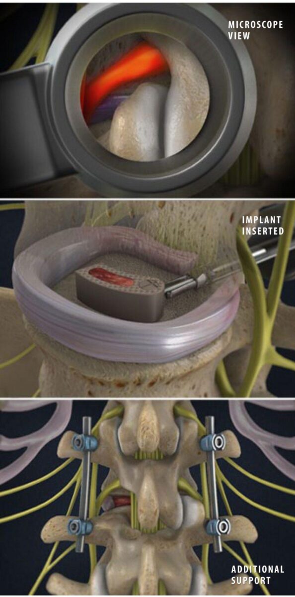 minimally-invasive-tlif-transforaminal-lumbar-interbody-fusion