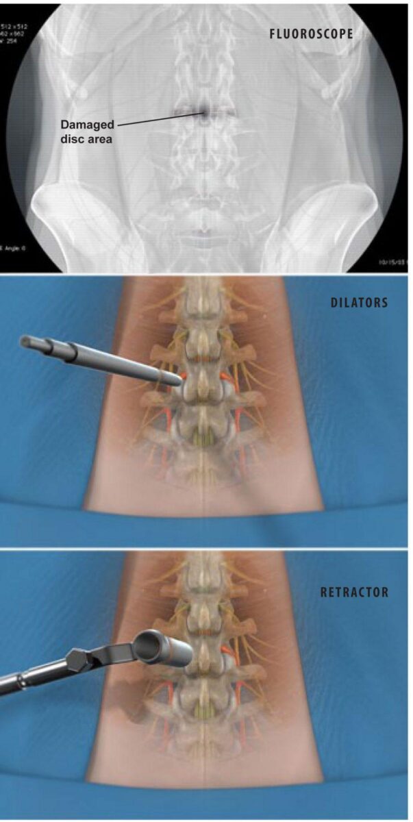 minimally-invasive-tlif-transforaminal-lumbar-interbody-fusion2