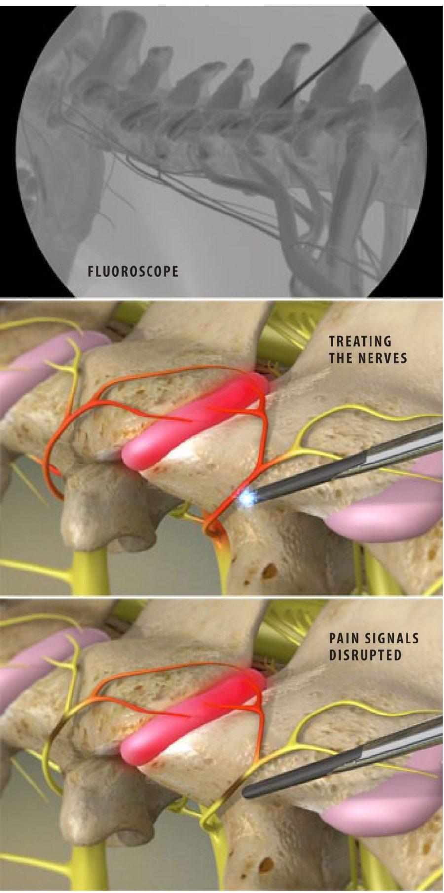 Radiofrequency Neurotomy of the Cervical Facets Plano, TX