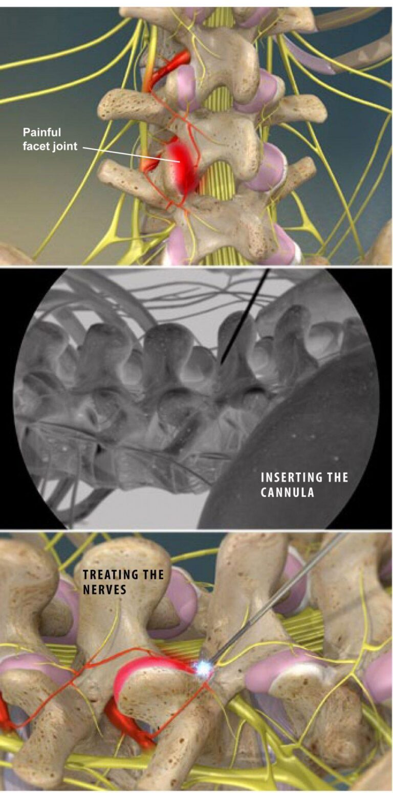 Radiofrequency Neurotomy of the Lumbar Facets Plano, TX