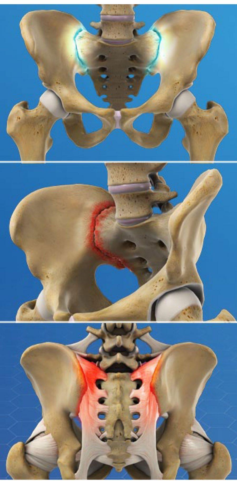 Sacroiliac Joint Pain  Novus Spine & Pain Clinic, Lakeland, Florida