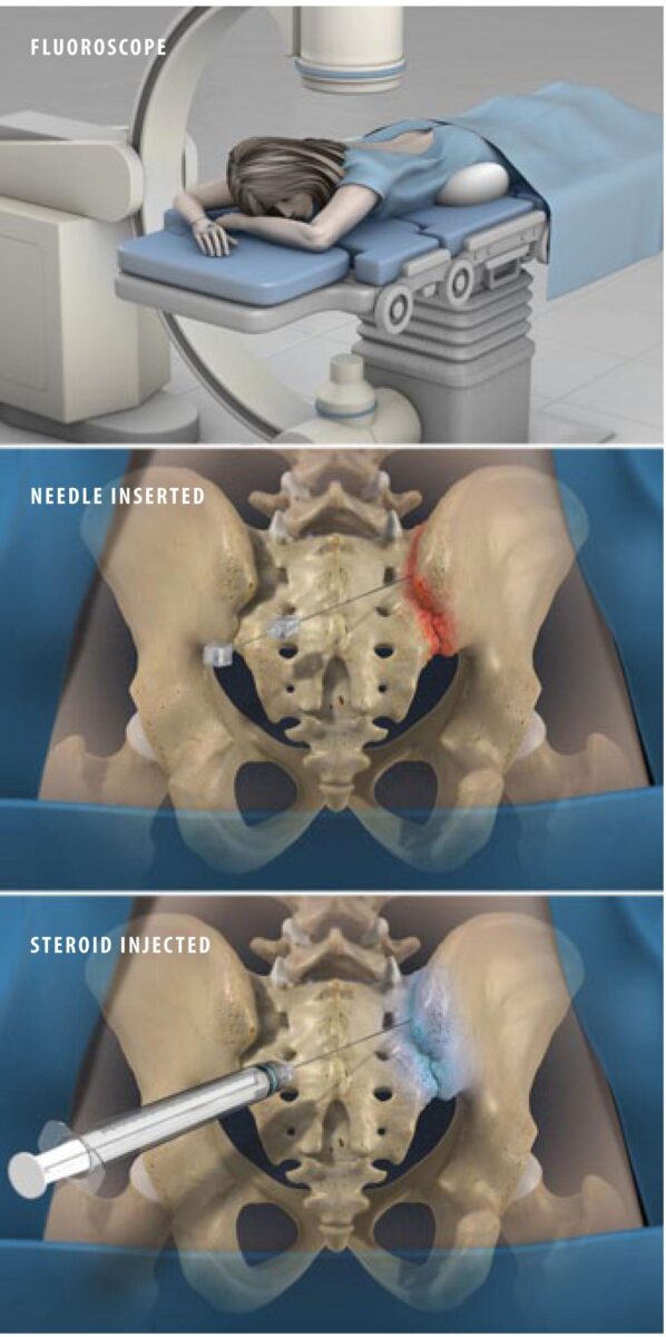 sacroiliac-joint-steroid-injection