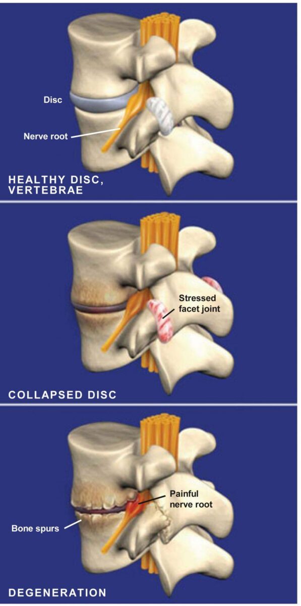 spondylosis-procedure