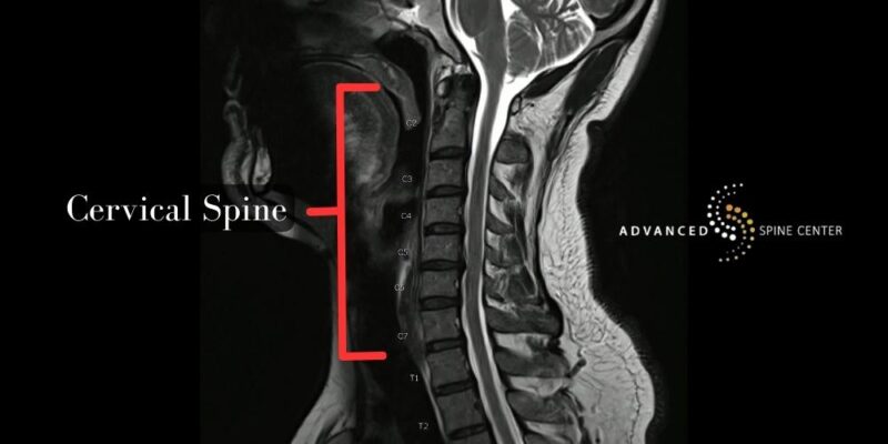 cervical fusion plano