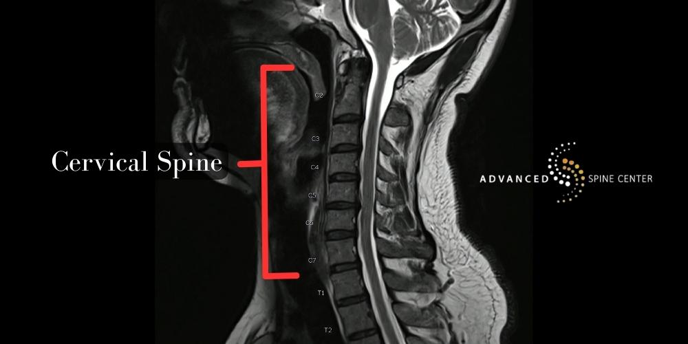 Cervical Fusion Surgery Plano, Texas