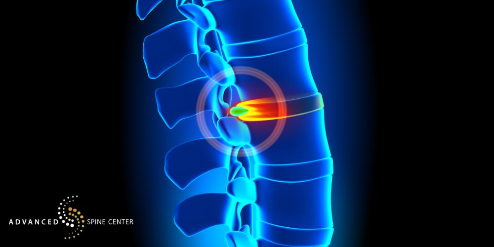 lumbar fusion mckinney