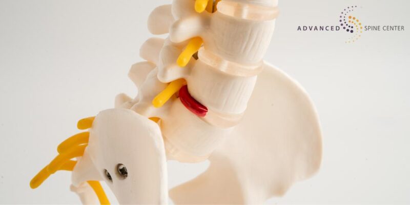 Herniated Disc Treatment Plano, TX | Advanced Spine Center