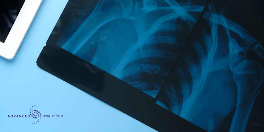 Burst Fracture Diagnosis