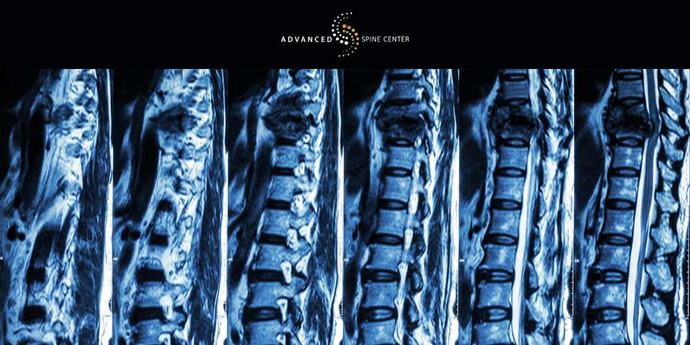 Compression Fractures