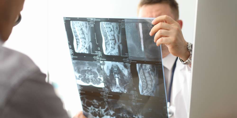 Kyphosis Treatment Plano