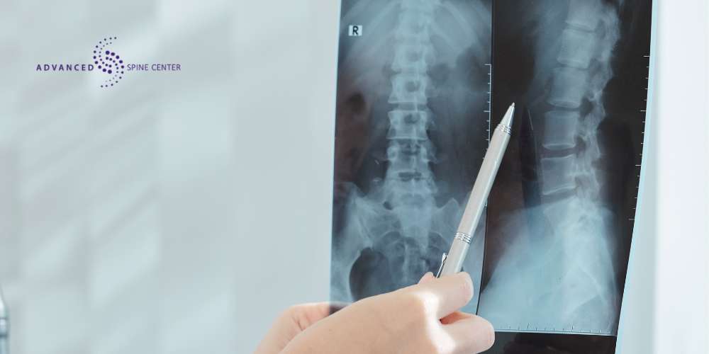 Diagnosing Myelopathy Plano TX