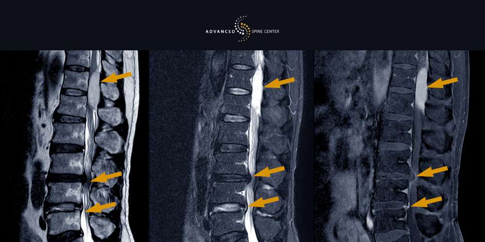 Foraminal Stenosis Treatment Plano TX