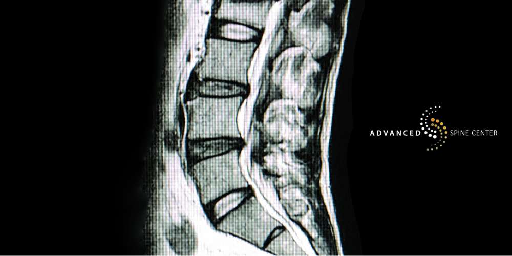 Is Kyphosis Reversible