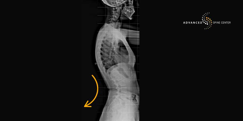 Lordosis Treatment Plano TX