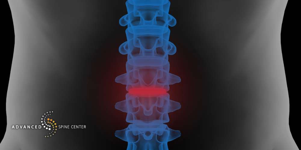 Lumbar Artificial Disc Replacement in Plano, TX