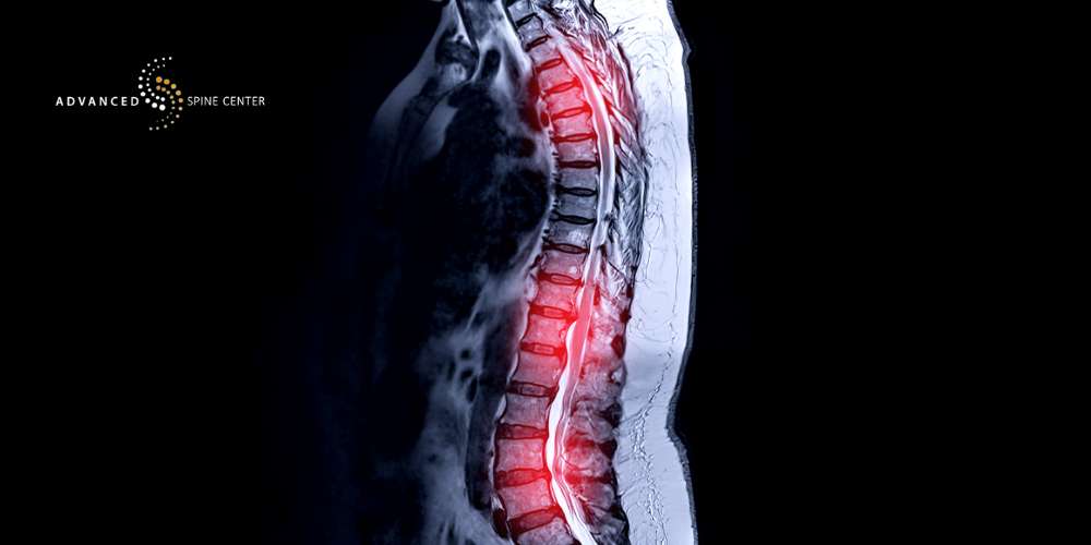 Myelopathy Treatment Plano TX