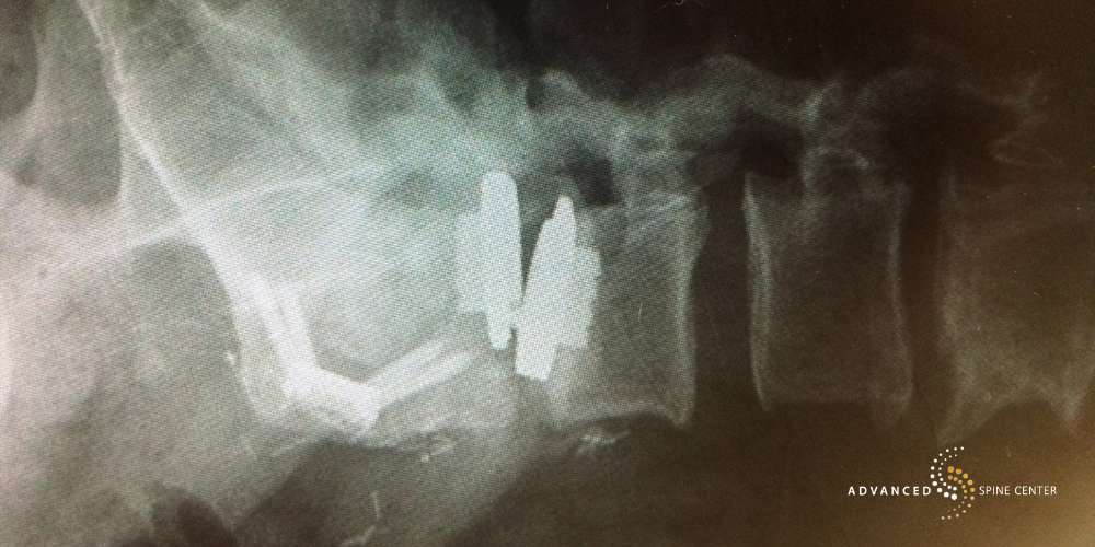 Potential Risks and Problems with Artificial Disc Replacement