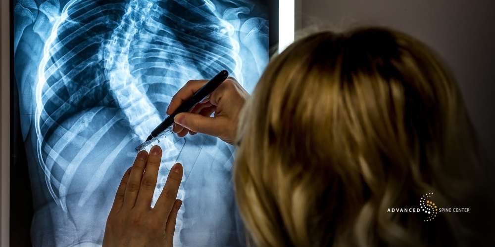 Scoliosis Diagnosed Plano TX