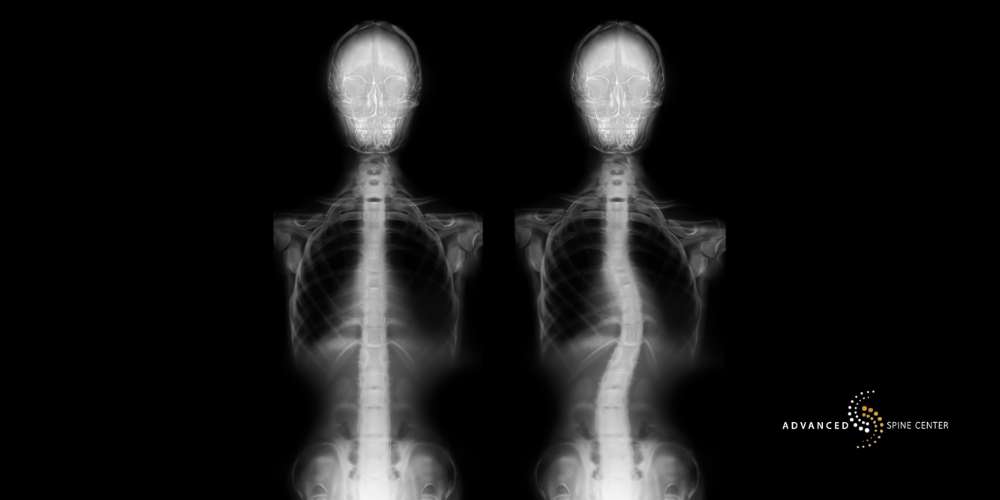 Scoliosis Treatment Plano, TX