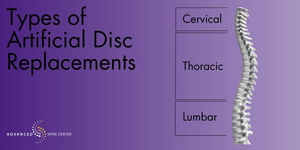 Types of Artificial Disc Replacement