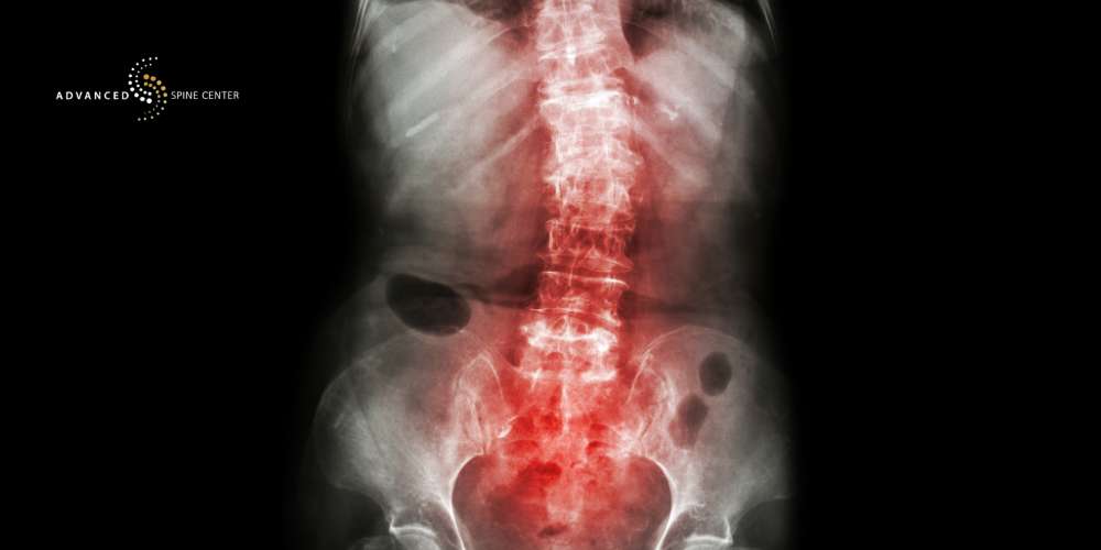 Types of Scoliosis Plano TX