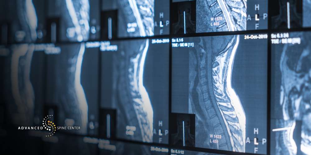 Vertebroplasty Surgery Plano TX