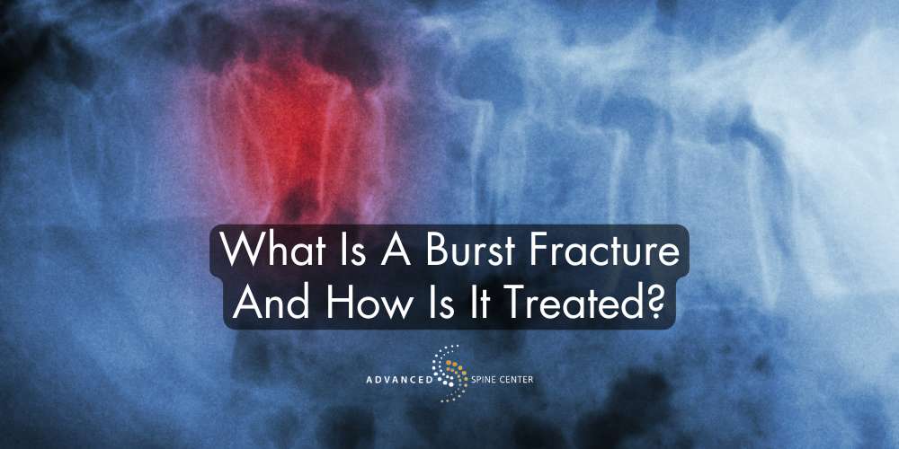 What Is a Burst Fracture and How Is It Treated