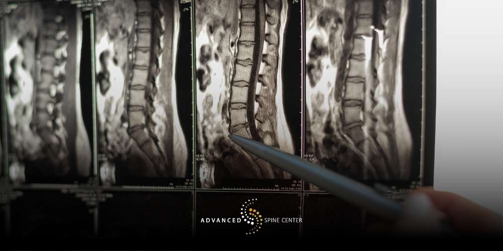 Why Is Artificial Disc Replacement Surgery Performed
