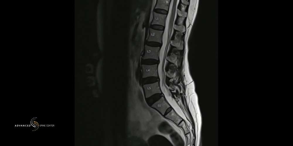 cauda equina surgery plano tx