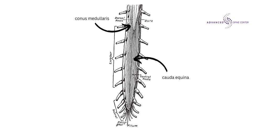 cauda equina syndrome treatments plano tx