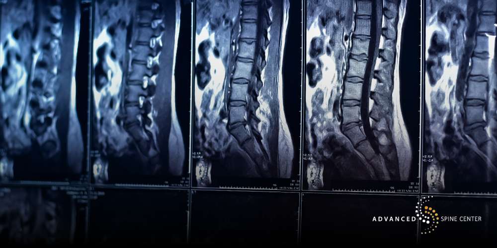 plano lumbar disc replacement