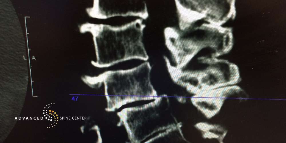 what is the newest treatment for spinal stenosis