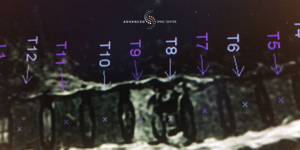 Common Locations in the Spine for Compression Fractures